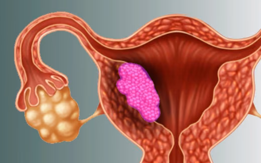 Endometrium (Rahim) Kanseri Tedavisi — Doç. Dr. Deniz Şimşek, Bursa