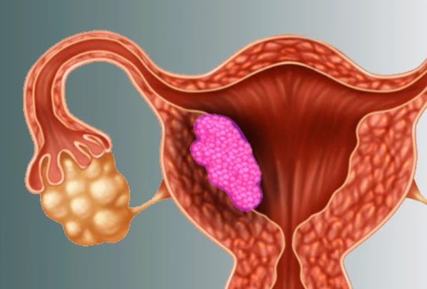 Endometrium (Rahim) Kanseri Tedavisi — Doç. Dr. Deniz Şimşek, Bursa