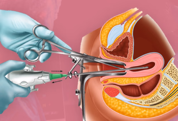 Kürtaj — Doç. Dr. Deniz Şimşek, Bursa