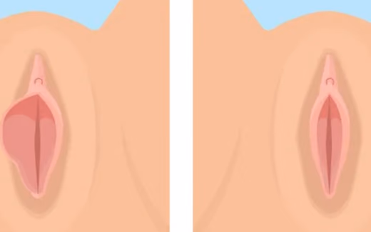Labioplasti — Doç. Dr. Deniz Şimşek, Bursa