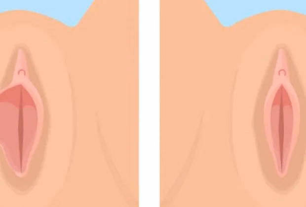 Labioplasti — Doç. Dr. Deniz Şimşek, Bursa