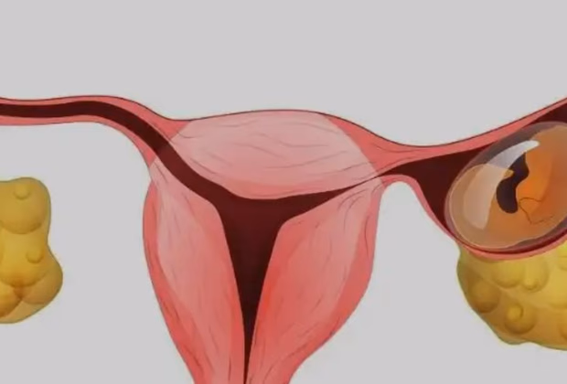Dış Gebelik — Doç. Dr. Deniz Şimşek, Bursa