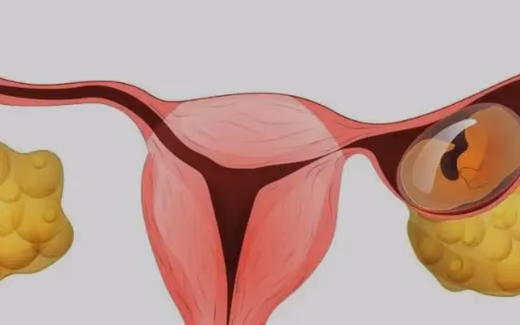 Dış Gebelik — Doç. Dr. Deniz Şimşek, Bursa