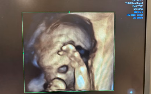 Dört Boyutlu Ultrasonografi — Doç. Dr. Deniz Şimşek, Bursa