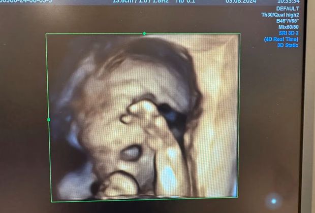 Dört Boyutlu Ultrasonografi — Doç. Dr. Deniz Şimşek, Bursa