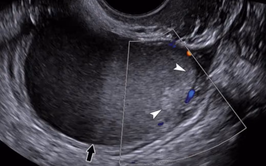 Endometrioz Tedavisi — Doç. Dr. Deniz Şimşek, Bursa