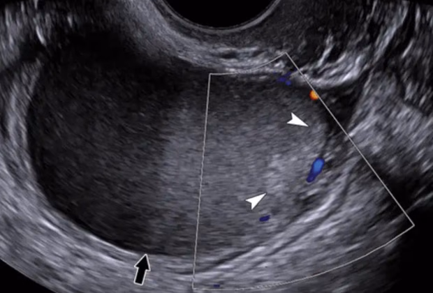 Endometrioz Tedavisi — Doç. Dr. Deniz Şimşek, Bursa