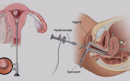 Histeroskopi — Doç. Dr. Deniz Şimşek, Bursa