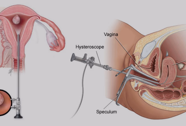 Histeroskopi — Doç. Dr. Deniz Şimşek, Bursa