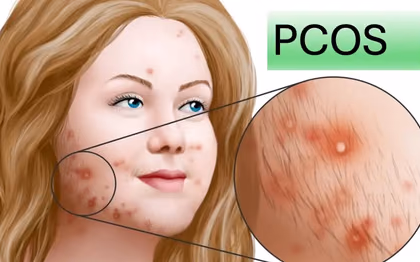 PCOS (PKOS) Tedavisi — Doç. Dr. Deniz Şimşek, Bursa