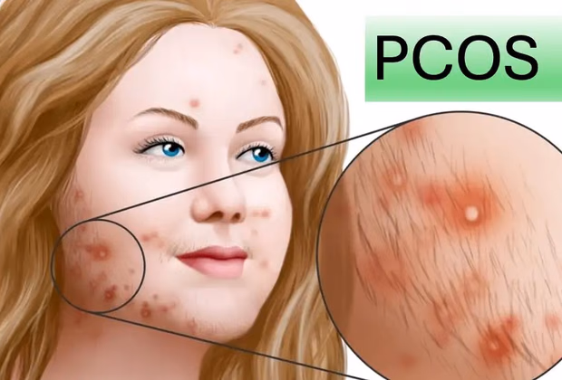 PCOS (PKOS) Tedavisi — Doç. Dr. Deniz Şimşek, Bursa