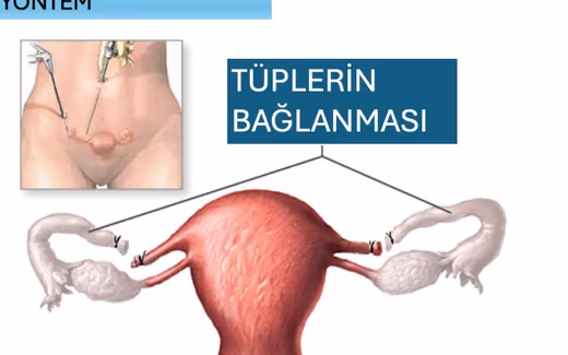 Tüp Bağlama Ameliyatı — Doç. Dr. Deniz Şimşek, Bursa