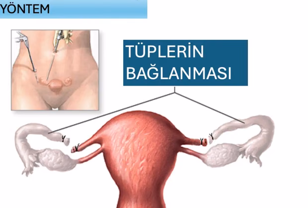 Tüp Bağlama Ameliyatı — Doç. Dr. Deniz Şimşek, Bursa